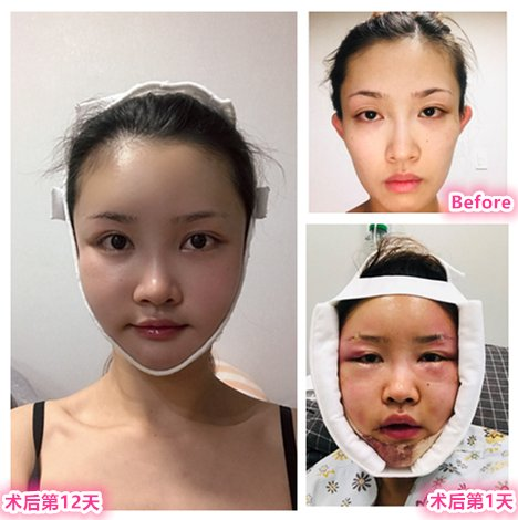 before and after (3-point facial contouring, fat transfer, lower eyelid fat repositioning)